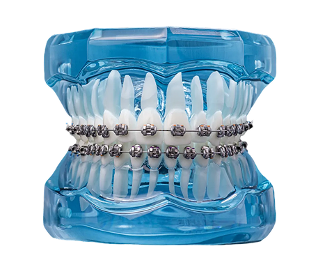 about-aligners
